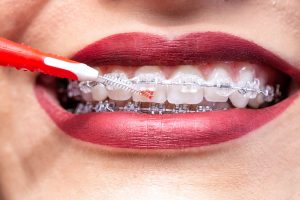 ¿Cómo Limpiar Tus Dientes Si Tienes Brackets En Panamá?