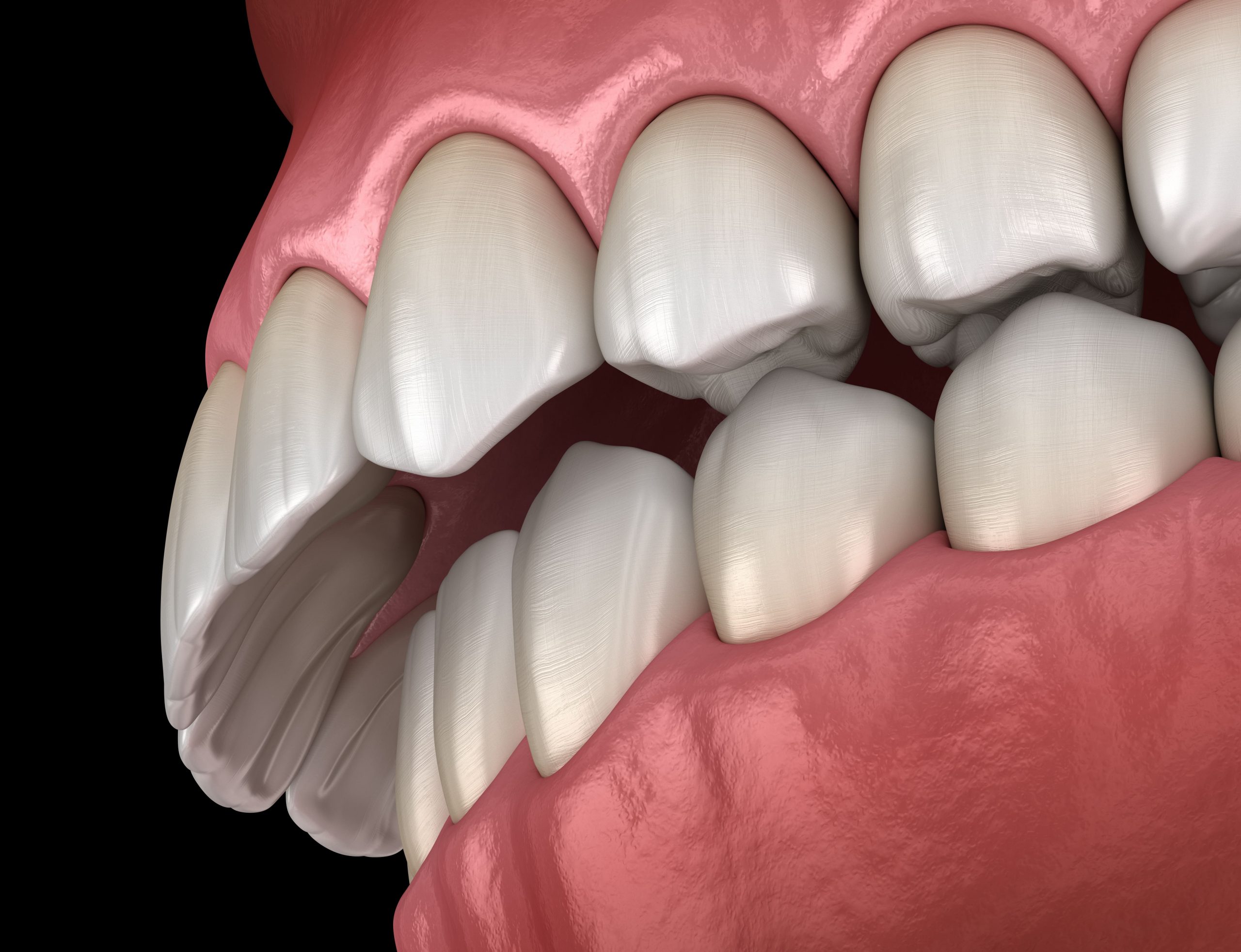 Maloclusión dental en Panama - Dental One - Mejora tu sonrisa este 2023