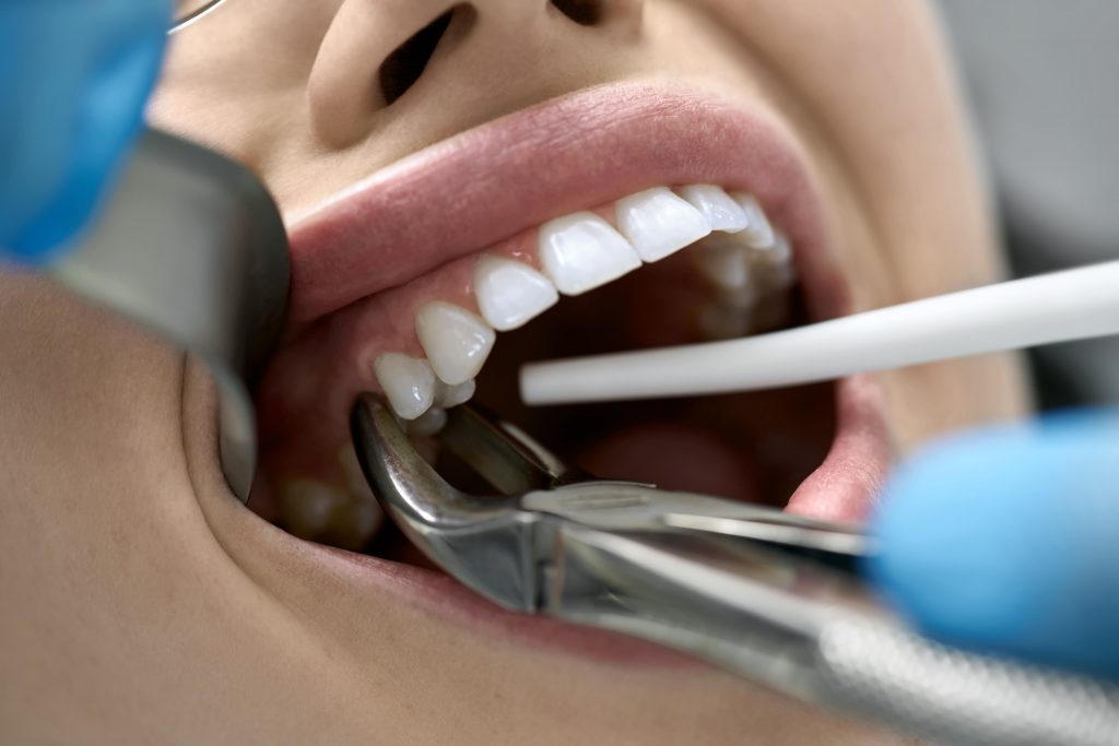 Extracción dental o exodoncia en Panamá