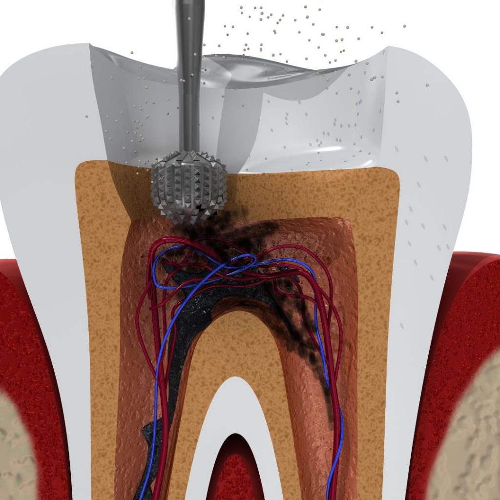 Root Canals In Panama