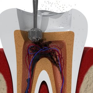 Conductos Radiculares O Endodoncias En Panamá