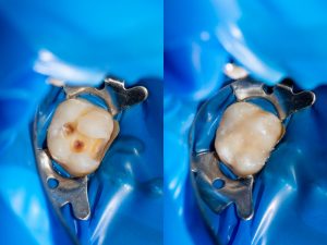 Amalgamas Dentales en Panamá