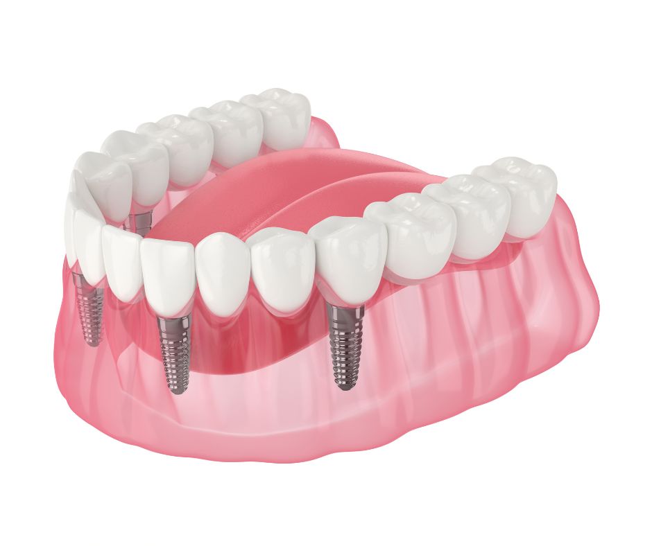 https://dentalonepanama.com/implantes-dentales-en-panama/