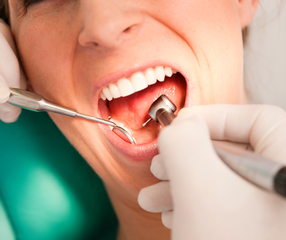 Price of a Dental Cleaning in Panama