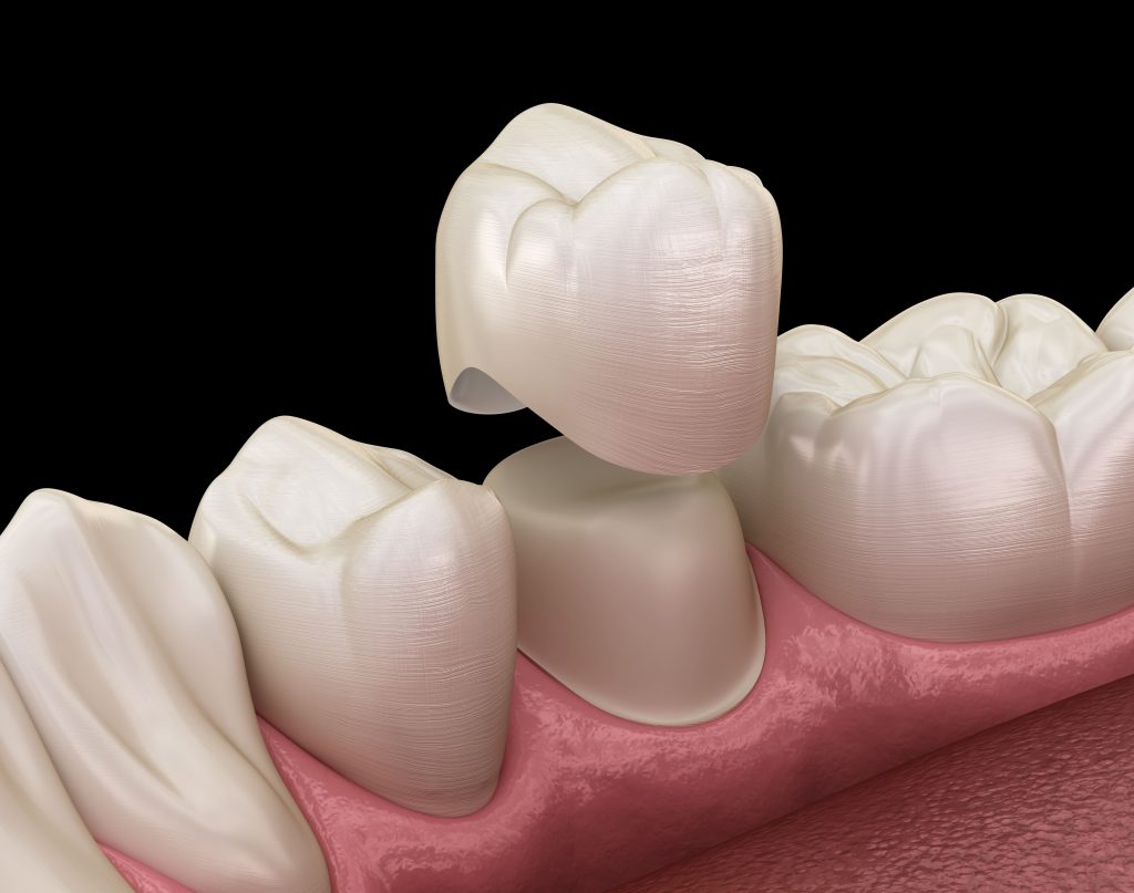 FAQs About Dental Crowns in Panama