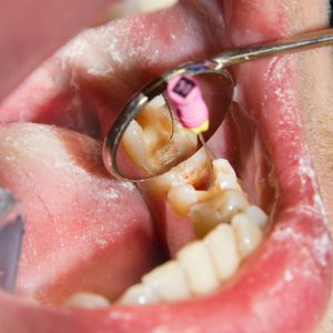 root canal treatment in Panama