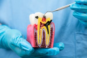 What Happens If I Don’t Get a Root Canal on Time?