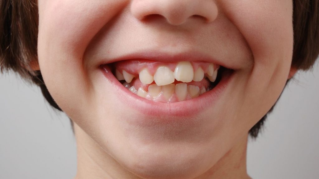 What to Do If My Child’s Teeth Are Coming In Crooked?