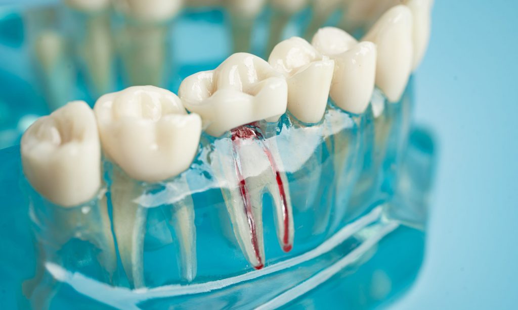 Kill the Nerve of a Tooth
