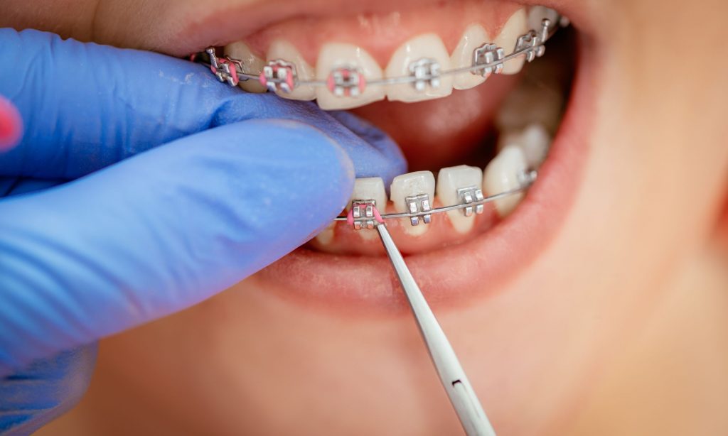 How to take care of my braces