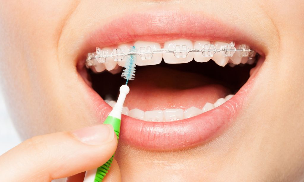 How to take care of my braces