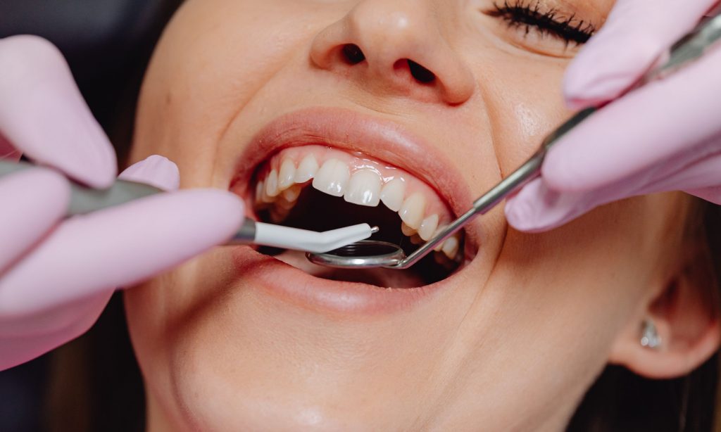 Crown Lengthening