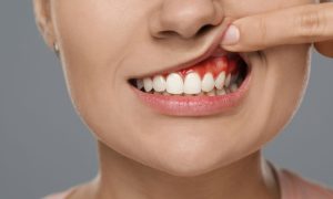 Dental Abscess in Panama