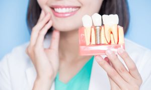 Is There an Alternative to Traditional Dental Implants in Panama?