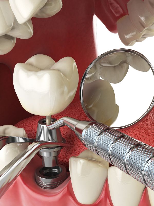Alternative to Traditional Dental Implants in Panama