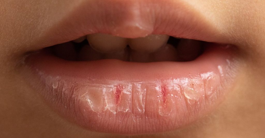 dry mouth symptoms and solutions