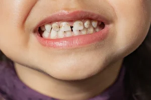 Hipoplasia Dental en Panamá: Causas y Tratamientos