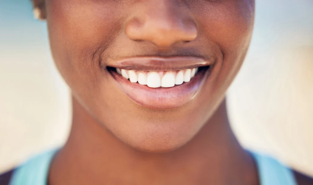 Blanqueamiento dental - Costa del Este - Dental One
