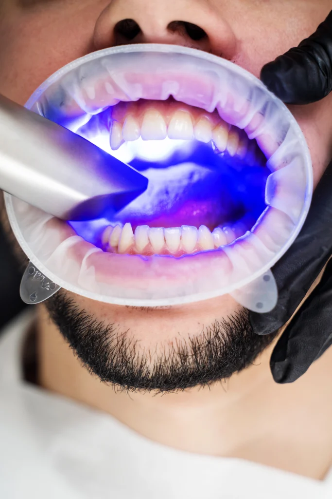 Teeth Whitening in Panama - Dental One