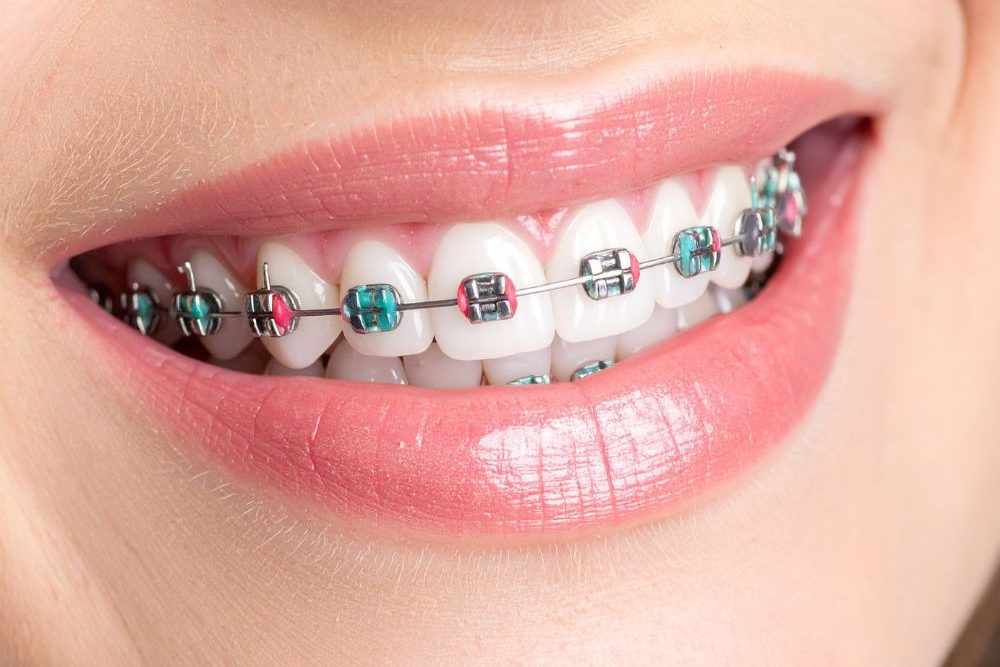 Brackets Metálicos Dental One