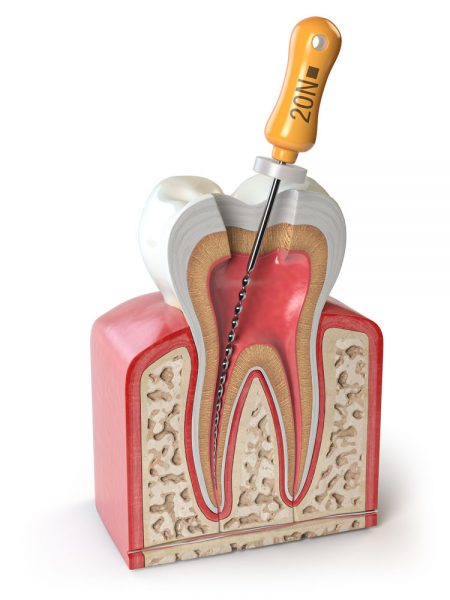 Cross section of Human tooth with endodontic file isolated on white. 3d illustration
