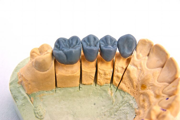 Close up image of wax teeth on the model, dentist laborator